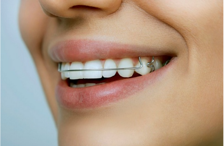 تقويم الاسنان